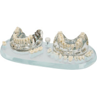 Studienmodell Demo Implant C&B - 1 db - 355638
